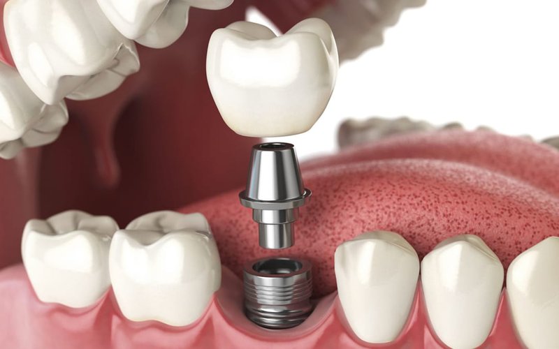 Phẫu Thuật Cấy Ghép Implant