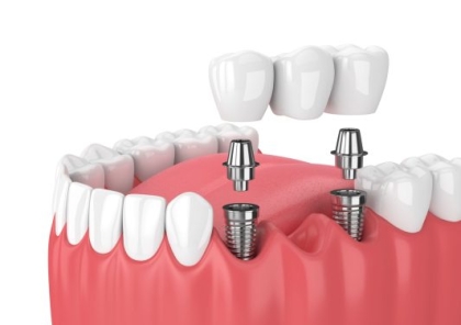 Trụ Implant